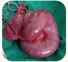 Rare Case of Meckel’s Diverticulum Causing Antegrade Ileoileal Intussusception